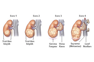 Böbrek Kanseri Evreleri - Prof. Dr. Sinan Zeren