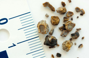 Böbrek Taşı - Prof. Dr. Sinan Zeren