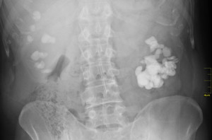 Böbrek Taşı Teşhisi - Prof. Dr. Sinan Zeren