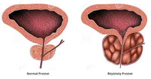 Normal Prostat ve Büyük Prostat - Prof. Dr. Sinan Zeren
