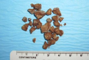 Böbrek Taşı - Perkütan Böbrek Cerrahisi - Prof. Dr. Sinan Zeren