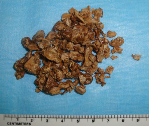 Böbrek Taşı - Perkütan Böbrek Cerrahisi - Prof. Dr. Sinan Zeren